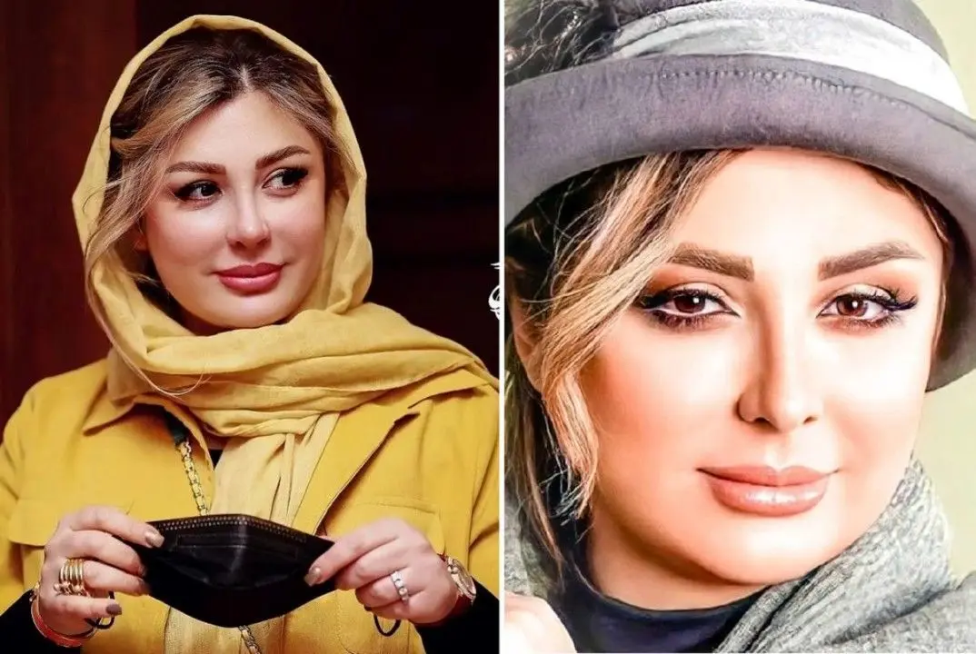 صورت نیوشا ضیغمی بخیه لازم شد | زخم خونی نیوشا ضیغمی روی صورتش غوغا کرد