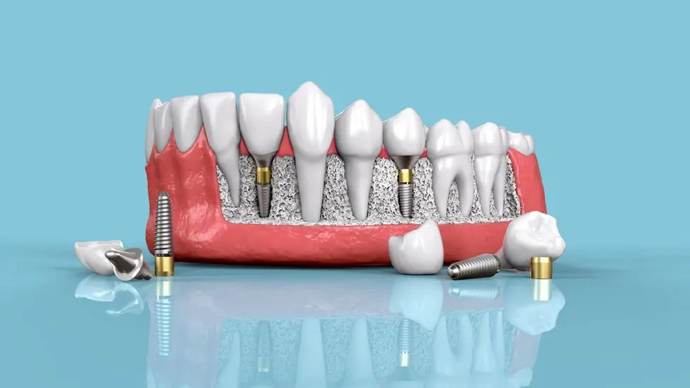 چرا پرداخت هزینه ایمپلنت دندان, نوعی سرمایهگذاری محسوب میشود؟